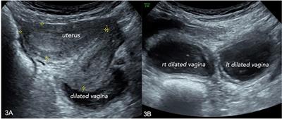 Ultrasound-guided endoscopy to improve accuracy of persistent urogenital sinus (PUGS) diagnosis in adult patient: A case report